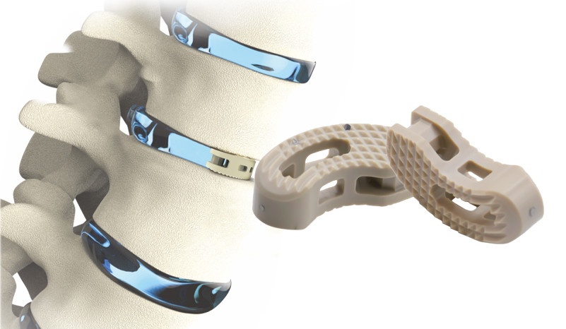 Implantes lumbares: una guía completa