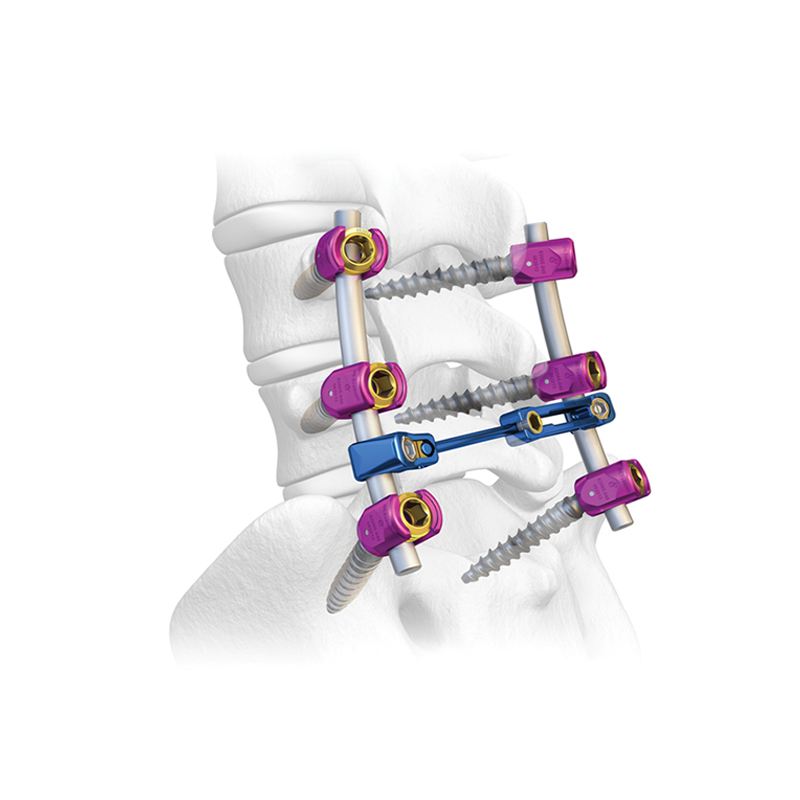 Sistema de tornillo pedicular espinal 6.0