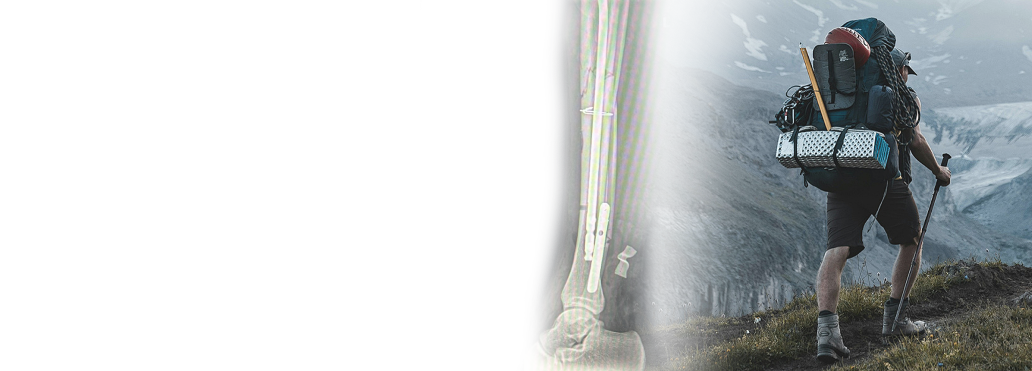 Caso de fijaci&oacute;n de fractura de tibia en M&eacute;xico con tibial clavo y placa circular 